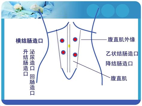 灶口|浅谈造口的类型和定位